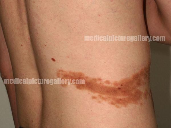 Inflammatory linear verrucous epidermal nevus