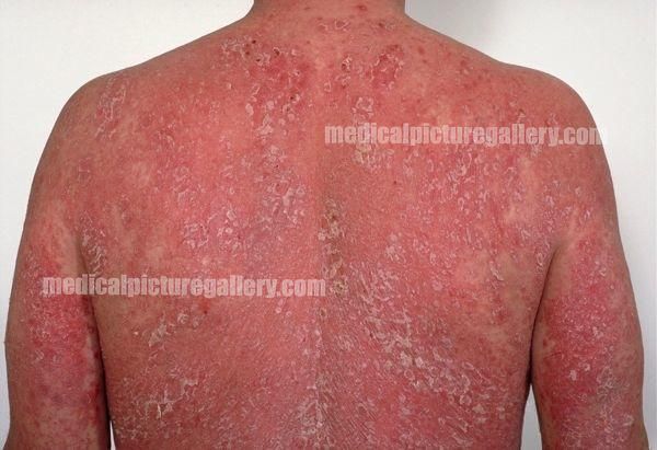 Psoriasis erythrodermica