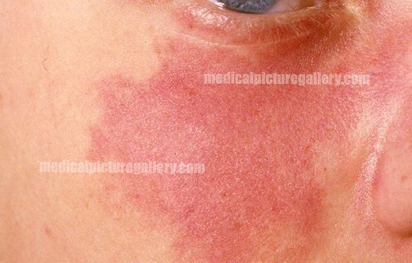 Port-wine stain / naevus flammeus