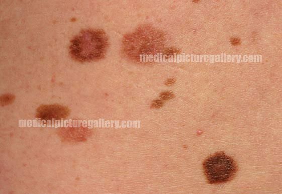 Compound nevus