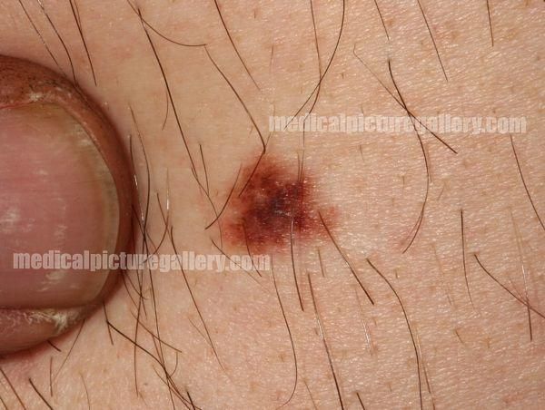 Pigmented nevus
